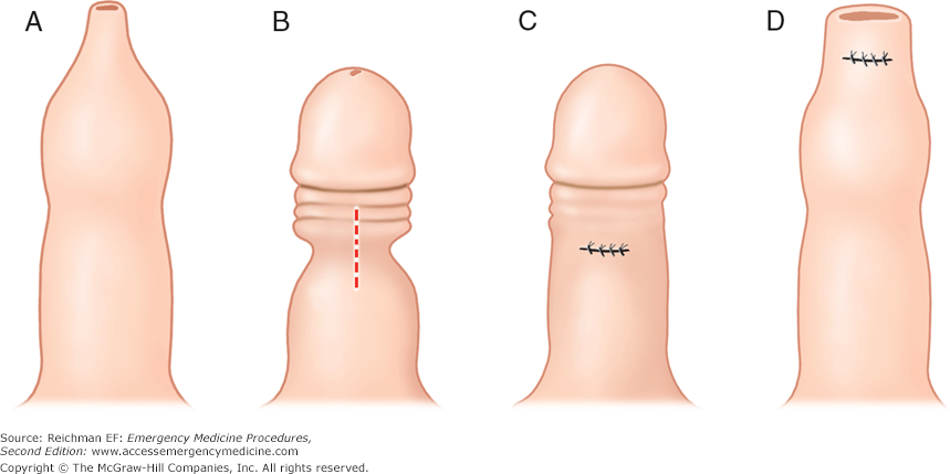 Preputioplasty