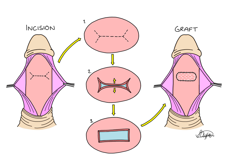 Lue incision and graft