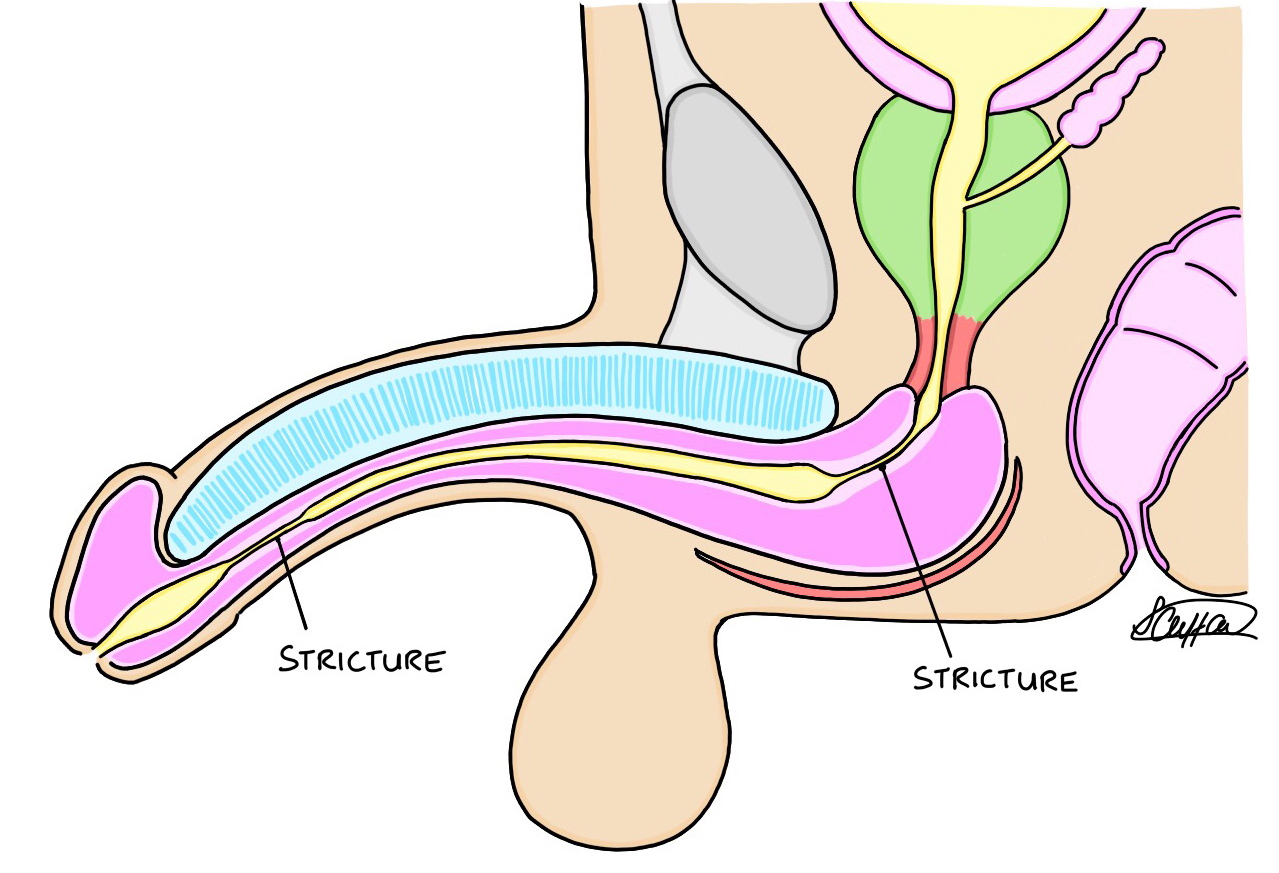 Urethral strictures