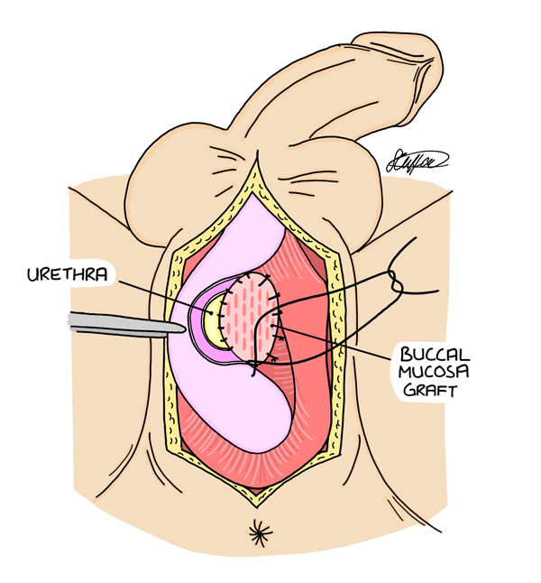 Buccal graft urethroplasty
