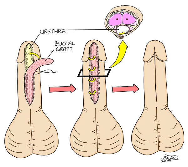 Penile urethroplasty